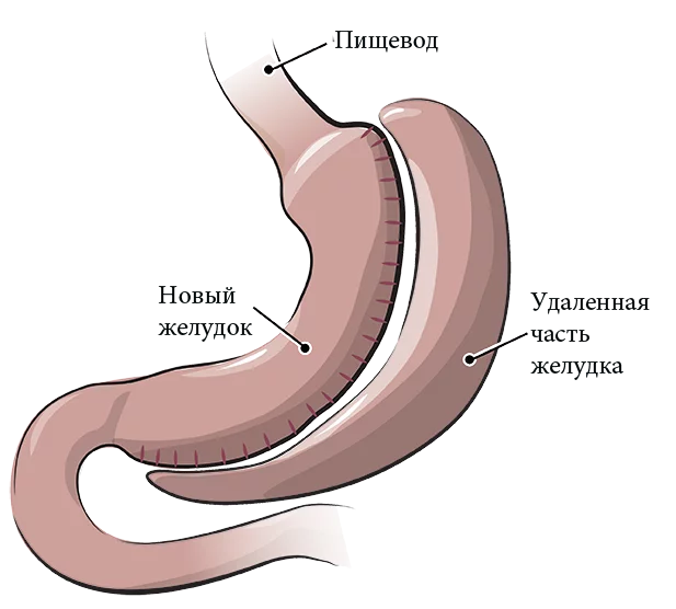 Что такое резекция желудка?